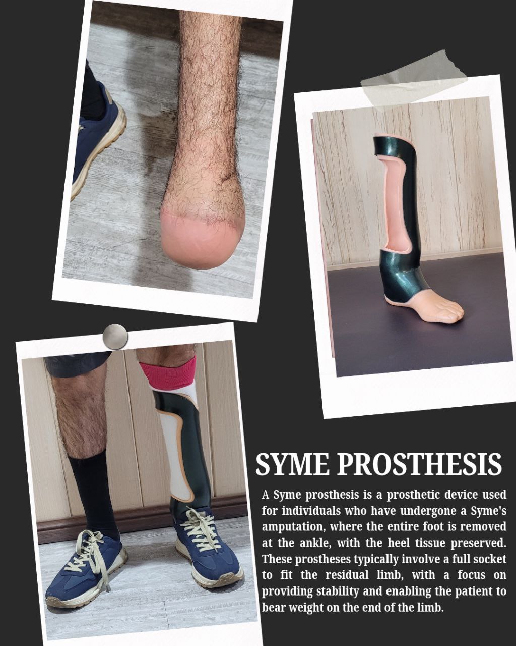 پروتز روی مچ پا