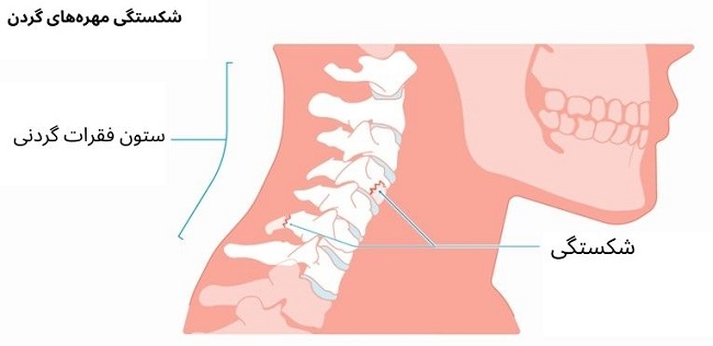 شکستگی مهره‌های گردن
