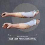 پروتز دست مصنوعی