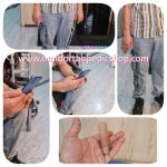 پروتز انگشت