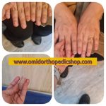 پروتز انگشت