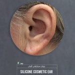پروتز گوش (گوش مصنوعی سیلیکونی زیبایی) Cosmetic Silicone ear prosthesis