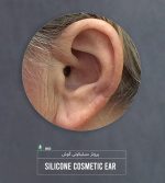 پروتز گوش (گوش مصنوعی سیلیکونی زیبایی) Cosmetic Silicone ear prosthesis